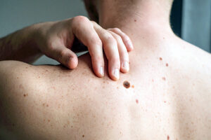 Checking benign moles. Close up detail of the bare skin on a man